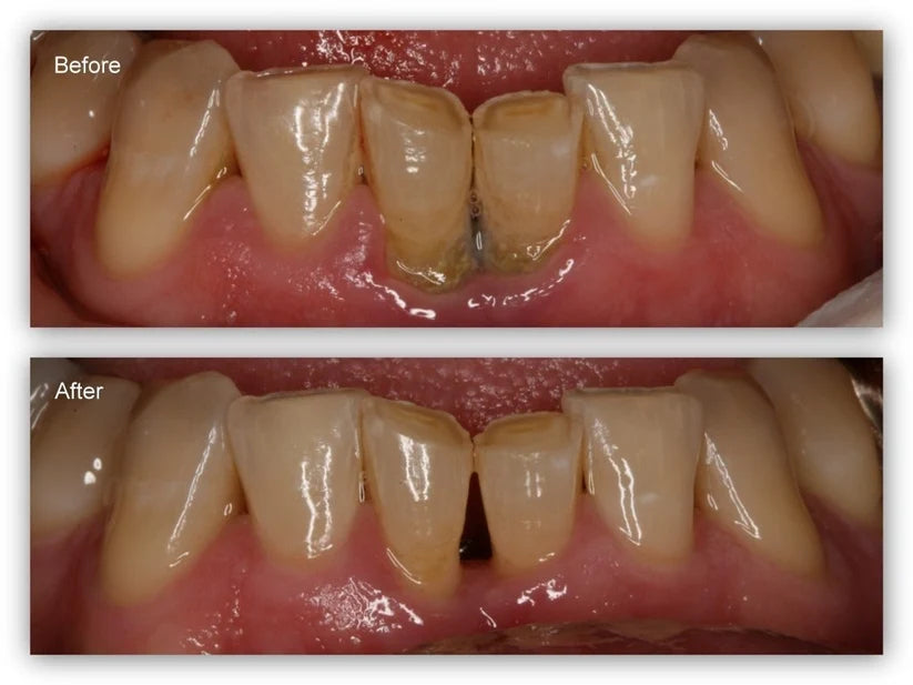 📢📢50% Off!!⏰ Teeth Whitening & Repair Gel 🦷
