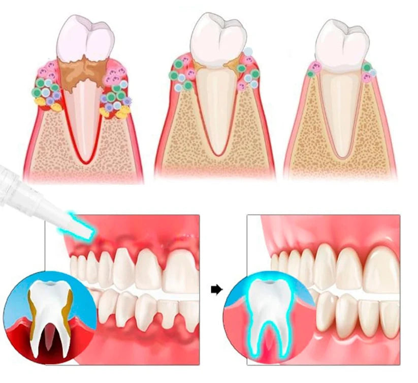 📢📢50% Off!!⏰ Teeth Whitening & Repair Gel 🦷