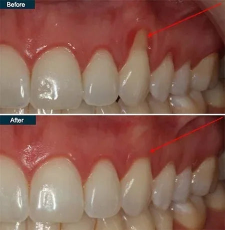 📢📢50% Off!!⏰ Teeth Whitening & Repair Gel 🦷