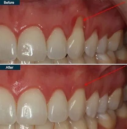 📢📢50% Off!!⏰ Teeth Whitening & Repair Gel 🦷